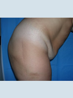 Abdominoplasty and abdominal Dialing before