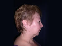 Skin Rejuvenation before