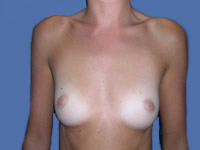Breast Augmentation before