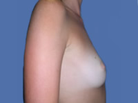 Breast Augmentation before
